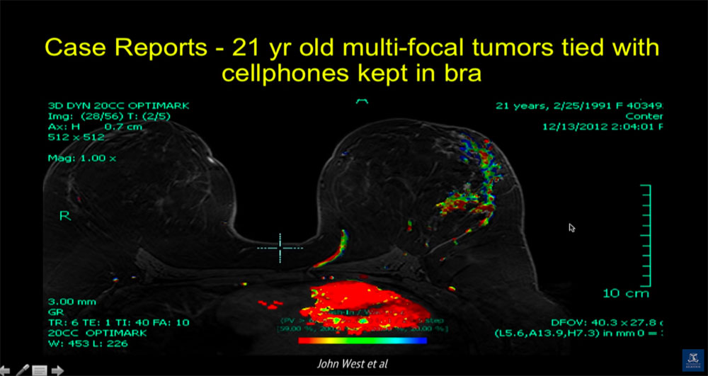 Breast cancer in rectangular shape from smart phone RF radiiation